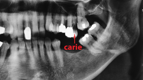 consequences-perte-de-dents