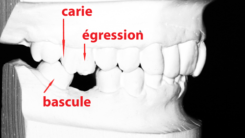 consequences-perte-de-dents2