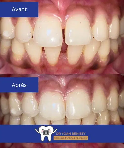 orthodontie-adulte-correction-trou-devant