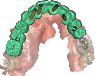 realisation-prothese-informatique-dr-boutin-dentiste-paris